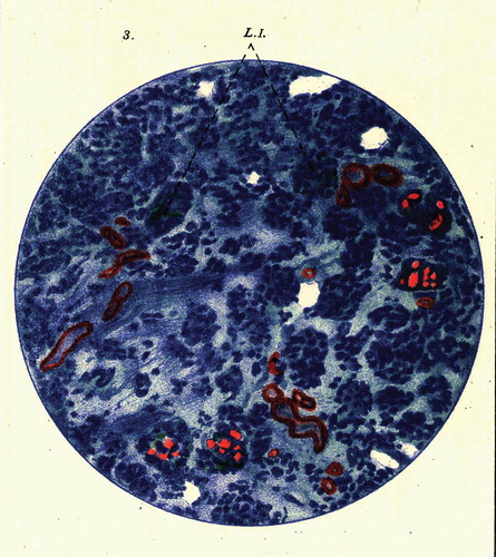 Figure 3. Figure form Gellerstedt’s paper from 1938 showing islet amyloid in a patient with systemic amyloidosis. Although we do not know what type of systemic amyloidosis it is, AA amyloidosis was by far the most common form in Sweden at that time. Note the colour differences between the amyloids. The depicted section was stained with methyl violet.