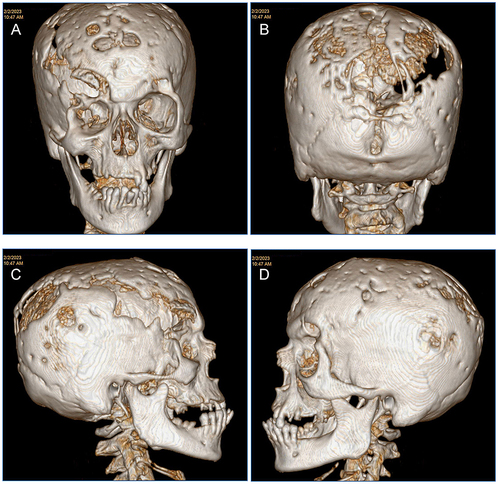 Figure 2 Three-dimensional reconstruction of computed tomography of the patient on admission showing multifocal osteolytic calvarial erosions, (A) anterior; (B) posterior; (C) right; (D) left.