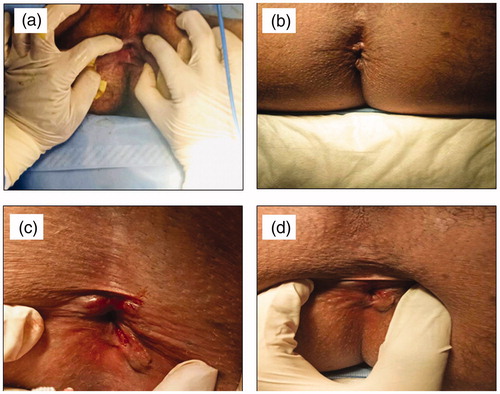 Figure 3. Representative photographs of patients suffering from either AAF (a) before treatment (baseline), (b) after treatment for six weeks with the optimized combination gel (F2) or CAF, (c) before treatment (baseline), and (d) after treatment for six weeks with the optimized combination gel (F2).