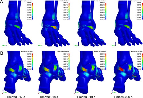 Figure 4. Maximum principal strain contours of the ligaments (ankle with dorsiflexion of 30° falling from 5 m). (A) Anterior aspect. The maximum principal stress of the anterior talofibular ligament and anterior tibiotalar ligament appears an obvious increase, indicating a high injury risk. (B) Posterior aspect. The maximum principal stress of posterior talofibular ligament and posterior ligament appears an obvious increase, indicating a high injury risk. (Each column is at the same time point).