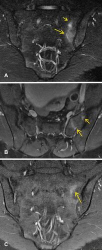 Figure 7 (A) Coronal view sacral T2 MRI with enhancement depicted by yellow arrows. (B and C) Axial and coronal view T1 MRI, respectively, showing post contrast enhancement depicted by yellow arrows. When these findings are seen concurrently in a patient, it is representative of bone marrow edema, which can be a sign of sacroiliitis.