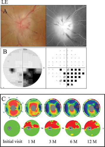 Figure 4. A 66-year-old female with inferior altitudinal field loss (case 1). (A) Left: a fundus photograph showed optic disc swelling; Right: FA images showed leakage of the optic disc. (B) Left: grey scale; Right: pattern deviation. The Humphrey visual field test showed inferior altitudinal field loss along the horizontal meridian. (C) Top: the cpRNFL significance map; Bottom: the GCC significance map. The cpRNFL significance map was increased at the initial visit and at 1 month due to optic disc swelling, and a significant reduction was observed at 3 months in the superior temporal sectors. The GCC significance map at 1 month showed thinning of the superior hemifield along the horizontal meridian corresponding to the inferior altitudinal field loss. The thinning area gradually spread over time. LE = left eye.