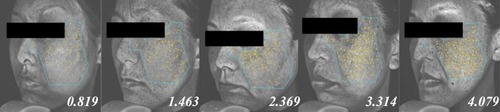Figure 1 Examples of VISIA UV photoimages and UV Pigmented Spot scores. Images of five subjects in the study; the number at the bottom of each image is the PS score.