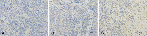 Figure 1 Immunohistochemical staining for expression of HOXA9 in nasopharyngeal carcinoma (NPC) and mucosal tissue of chronic nasopharyngitis (SP×400). (A) low HOXA9 expression in mucosal tissue of chronic nasopharyngitis. (B) low HOXA9 expression in NPC tissue. (C) high HOXA9 expression in NPC tissue.