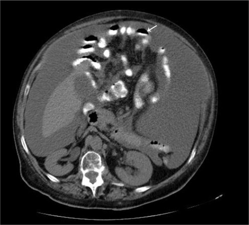 Figure 1 Computed tomographic scan of abdomen showing pseudomyxoma peritonei with multiple peritoneal masses (arrow) with “scalloping effect.”