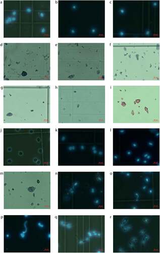 Figure 2. Isolated nuclei. a–c) Undamaged round nuclei isolated from muscle-invasive human bladder tumors. a) Sample 59, b) Sample 64, and c) Sample 71. d–f) High degree of debris observed when nuclei isolation is performed with manual dissociation with pestles combined with d-e) Igepal lysis buffer (sample 34) and f) Nuclei EZ lysis buffer (sample 11). g–i) Nuclei treated with Nuclei EZ lysis buffer were g–h) shrunken and oblonged and had I) a spikey circumference. g) Sample 13, h) Sample 25 and i) Sample 6. j–k) Undamaged round nuclei isolated from a T24 human bladder cancer cell line using 5 min. incubation in IgePal Lysis Buffer. l) Undamaged round nuclei isolated from a non-muscle invasive human bladder tumor (sample 76). m) Swollen and blebbing nuclei resulting from prolonged incubation of a human bladder tumor (sample 27). n–p) DNA leakage from prolonged incubation of human bladder tumors for n–o) >5 min. and p) >3 min. n) Sample 43, o) Sample 50, and p) Sample 70. q–r) Incomplete nucleus isolation from human bladder tumors with remains of the cytoplasmic membrane. q) Sample 56 and r) Sample 57. Nuclei are stained 1:1 with DAPI, Trypan Blue Solution, or Erythrosin and evaluated through a fluorescence or light microscope.