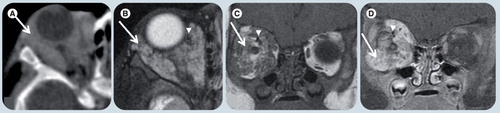 Figure 14. Infantile hemangioma.(A) Axial postcontrast soft-tissue window CT image, (B) axial T2-weighted, (C) coronal T1-weighted image (WI), and (D) coronal T1-weighted fat-suppressed postgadolinium MR images demonstrate a poorly circumscribed and heterogeneous lesion (white arrows) in the right orbit involving several compartments. (B) The tumor is hyperintense on T2-WI and (C) isointense on T1-WI relative to the muscles. Intense enhancement is depicted in both (A) CT and (D) MRI. There are flow-voids (white arrowheads) corresponding to blood vessels. The lesion is causing expansion of the bony orbit suggesting slow growth, chronicity and proptosis.