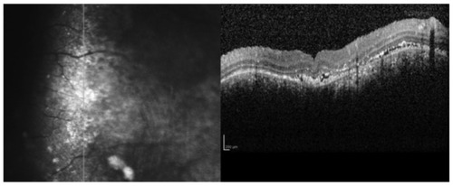Figure 2 Optical coherence tomography scans after treatment.
