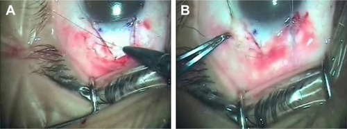 Figure 5 Closure of superficial scleral flap (A) and conjunctiva (B).