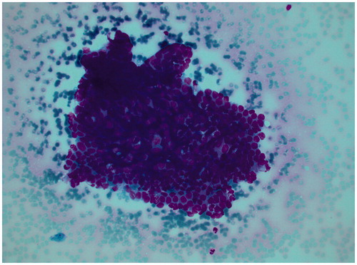 Figure 2. Cytological findings from the suspected tumor with the cell groups interpreted to represent malign epithelial cells.