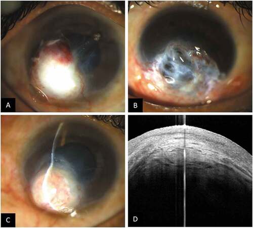 Figure 7. This collage of images illustrates the postoperative complications of tenon’s patch graft. a) Intratenon’s hemorrhage b) Tenon melt c) Pseudoectasia D) ASOCT showing thick tenon’s at 12 weeks postoperative period.