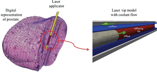 Figure 1. Illustration of relative position of laser applicator with respect to the digital representation of a prostate (left) and detailed model of the active cooling achieved by a coolant running at ambient temperature around a photon emitting diffusing laser tip (right).