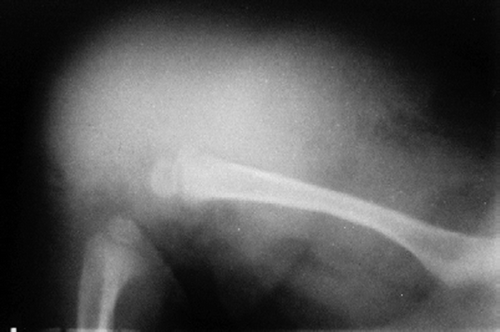 Figure 2. Soft tissue swelling with no bony involvement.