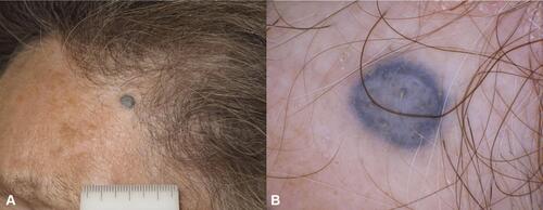Figure 8 Blue nevus. (A) A blue papule on the frontal area of a 50-year old woman. (B) In dermoscopy structureless blue pigmentation is detected.