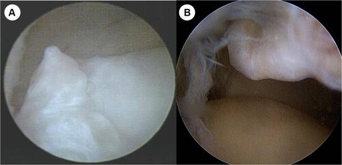 Figure 6 (A and B) Osteophytes formation at the anterior tibial plafond and the talar neck.
