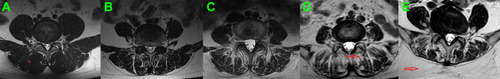 Figure 3 Goutallier grades 0 to 4 on T1W axial MRIs obtained at the L4-5 level are represented in Figures (A–E). The asterisk (A) indicates normal multifidus muscle signal, and the arrowhead indicates the high-signal fat located between the muscle and adjacent erector spinae (D), or in the subcutaneous area (E). The infiltration of fatty tissue gradually increases as the grade intensifies.