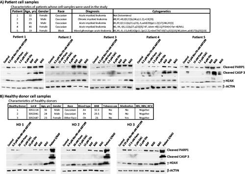 Figure 3. Drug effects on leukemia patient- and healthy donor-derived cells. Mononuclear cells were isolated from peripheral blood of (A) patients (characteristics shown in the upper panel) with hematological malignancies and (B) healthy donors, and exposed to the indicated drugs for 48 h prior to western blot analysis. Patient 2 cells exposed to triple drug combinations in panel B were used as positive control for western blot. Bis or B, bisantrene; ABT199 or A, venetoclax; Pano or P, panobinostat; DAC or D, decitabine; Ola or O, olaparib.