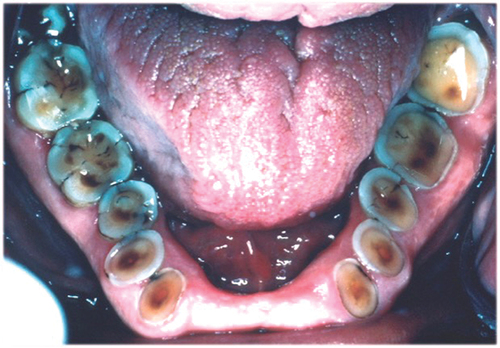 Figure 4. A clinical image demonstrating wear of the mandibular natural dentition opposing a maxillary complete denture with porcelain denture teeth.