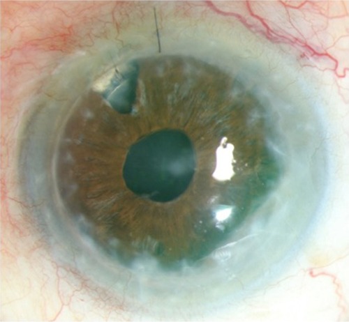 Figure 1 Color photography showing penetrating keratoplasty with peripheral opacification.