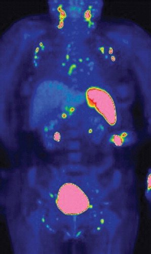 Figure 1. FDG PET/CT scan shows a symmetrical uptake in FDG-positive lymph nodes at the neck, supraclavicular fossa, axillary fossa, mediastinum, liver hilum, and along the iliaca vessels. Fused FDG PET/CT coronal image shows that the uptake correlates with bilaterally distributed lymph nodes in the axillary fossa and mediastinum, and the activated spleen is markedly increased as compared with the background FDG uptake in the liver.