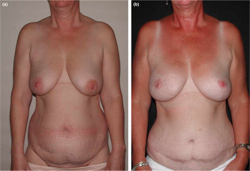 Figure 1.  Fifty years old female with invasive cancer in the right breast before (a) mastectomy and after (b) mastectomy and immediate breast reconstruction with a TRAM flap. The left breast has been corrected.