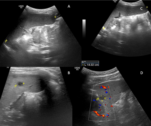 Figure 3 US findings in splenomegaly with different etiology.