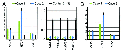 Figure 3. Quantitative real-time PCR analysis using placental samples. For a control, a pooled RNA sample consisting of an equal amount of total RNA extracted from three fresh control placentas was utilized. (A) Relative mRNA expression levels for DLK1, RTL1, and DIO3 against GAPDH (mean ± SE) and lack of MEGs expression (indicated by arrows) (miR433 and miR127 are encoded by RTL1as) in the placental samples of cases 1 and 2. (B) Relative mRNA expression levels for DLK1, RTL1, and DIO3 against GAPDH (mean ± SE), in the equal amount of expression positive placental cells (vascular endothelial cells and pericytes) of cases 1 and 2 (corrected for the difference in the relative proportion of expression positive cells between the placental samples of cases 1 and 2 and the control placental samples, on the assumption that the DLK1 expression level is ″simply doubled″ in the expression positive placental cells of case 1 and 2).