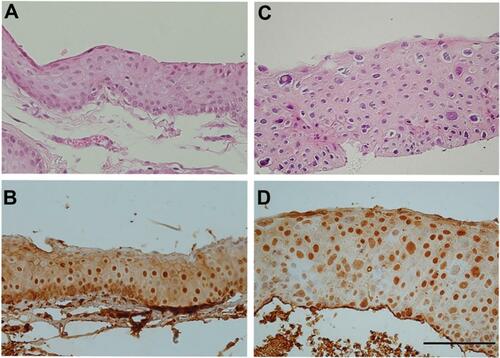Figure 2 (A–D) Intense nuclear staining in OSSN(Right) and control group (Left). Moderate intensity nuclear staining is specially observed in the basal epithelium of control group. Significance of nuclear staining is not clear. (A, C): H&E staining, (B, D): Immunohistochemistry staining for interleukin-6. Scale bar is 100 µm.Abbreviations: OSSN, ocular surface squamous neoplasia; H&E, hematoxylin and eosin.