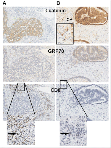 Figure 4. GRP78 expression is higher in CRC where CD8+ TILs cells are absent. (A) Two consecutive series of IHC representative of a relapse-free and (B) a relapse patient CRC are shown. β-catenin demarks tumor epithelium as well as invading tumor cells (open arrow) along with low GRP78 which is associated with greater CD8+ TILs. Black arrows identify CD8+ TILs.