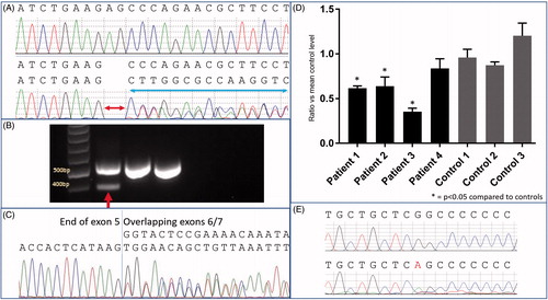 Figure 1. (A) Sanger sequencing of cDNA from a control (upper chromatograph) and Patient 2 (lower chromatograph) indicating overlapping sequences (blue arrow) that confirm a 2 and 21 nucleotide deletion. (B) Agarose gel electrophoresis of cDNA from Patient 7, indicating two PCR products (red arrow) revealing the normal-sized product and the smaller product with the 134 base pair deletion of exon 6 (the two lanes to right are normal controls with only a single normal-sized PCR product). (C) Sanger sequencing of the above PCR product indicates the presence of a heterozygous deletion of exon 6, with joining of exons 5 and 7. (D) RT-qPCR of SPG7 transcript levels demonstrate significantly reduced transcript levels in Patients 1, 2, and 3 (p < .05). (E) Sanger sequencing at the position of the c.1045G > A mutation from a control (upper chromatograph) and Patient 3 (lower chromatograph) demonstrating the mutation appears to be homozygous (although it is heterozygous in genomic DNA), indicating that cDNA from the opposite allele is not transcribed or is degraded.