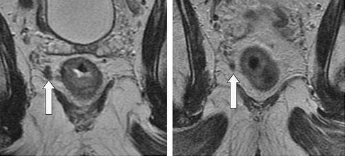 Figure 8.  Extramural venous invasion lying close to the mesorectal resection margin. The image on the right shows the same level after chemoradiotherapy with some downstaging evident.
