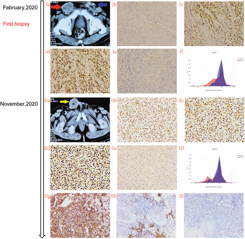 Figure 2. Different lesions represented MMR heterogeneity during treatment.