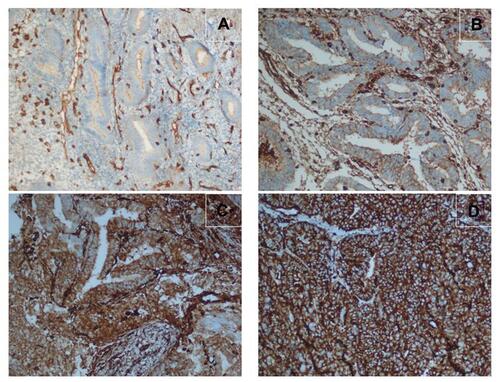 Figure 3 (A) Negative moesin expression in proliferative endometrial tissues. (B) Weak moesin expression in cases of endometrial hyperplasia without atypia. (C) Moderate moesin expression in cases of endometrial hyperplasia with atypia. (D) Severe moesin expression in endometrial cancer cases.