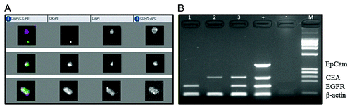 Figure 1. CellSearch analysis (A) and multiplex PCR performed after isolation of CTCs with AdnaTest (B) in three exemplificative patients with metastatic colorectal cancer. The figure shows that the absence of CTC at the CellSearch analysis is consistent with lack of EpCAM expression, as visualized at the AdnaTest analysis. Conversely, the approach with the multiplex PCR allows the identification of CTC underestimated by CellSearch, through the positive expression of EGFR and CEA.