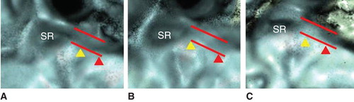 Figure 4. Occlusion patterns of the bony grooves of the saccular duct (BSD, yellow arrowhead) and endoloymphatic sinus (BES, red arrowhead). Dashed line shows original, normal diameter of BSD and BES. (A) BSD1, BES1; (B) BSD2, BES1; (C) BSD3, BES1. (See the Results section.)