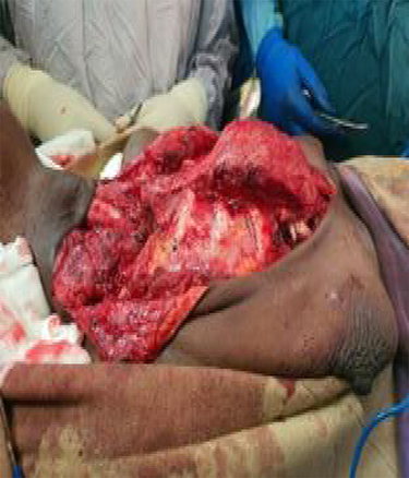 Figure 2 Intraoperative picture of the sternal mass after thyroidectomy and medial clavicular partial resection.