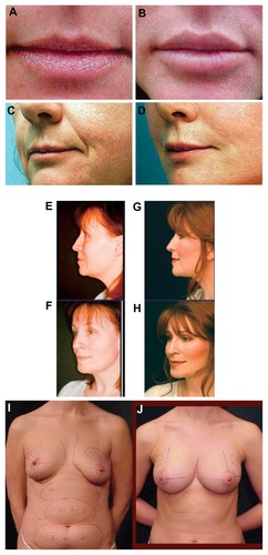 Figure 18 Clinical examples. Lips (A) pre- and (B) 1-year post-augmentation (autologous fat grafting [AFG] plus high-density platelet-rich plasma [HD PRP] [upper lip 3 cc; lower lip 2 cc]). (C) Pre- and (D) postoperative (20 months) AFG plus HD PRP grafting to lips, cheeks and nasolabial folds (lips: upper 2.5 cc; lower 2 cc; cheeks: 5 cc bilateral, malar and sub-malar placement; nasolabial folds: 3 cc bilateral). Cheeks (E and F) pre- and (G and H) 2 years post-AFG plus HD PRP (bilateral cheeks; total volume grafted, 5 cc bilateral malar and sub-malar) (Photos with permission). (I) Pre- and (J) postoperative (4 years) large-volume augmentation of both breasts (closed-syringe technique, cell-friendly cannulas) using AFG plus HD PRP concentrate; right, 300 cc; left, 325 cc).