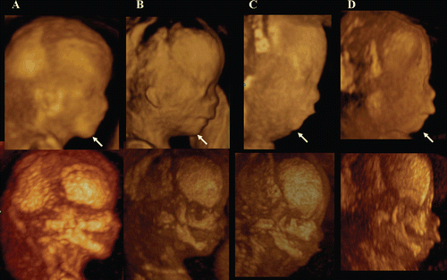 Figure 35.  Fetal profile and facial bone development in normal fetus (A) and abnormal fetuses (B,C,D) at 12–13 weeks of gestation. A; Normal fetus, B; Trisomy 21 fetus, C; Trisomy 18 fetus, D; Mild micrognathia with normal chromosome. Lateral views of fetal profile (upper figures) show the difference of chin-angle. Maximum mode images (lower figures) indicate the hypoplastic maxilla and mandible in B,C,D.
