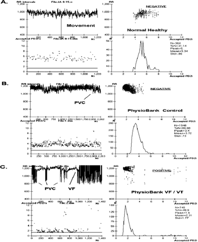 Figure 1 Relative risk (RR)-intervals and associated PD2i’s determined from the electrocardiogram (ECG) of a normal healthy person and two types of PhysioBank patients. A. Shows RR data and corresponding PD2i results from a normal healthy subject (15 min ECG). B. Shows results from an arrhythmia control patient (30 min ECG, PhysioBank). C. Shows results from a VF/VT patient (30 min ECG, PhysioBank). PD2i values are expressed in degrees of freedom (dimensions) and RR values in msec; VF is included in the analysis for illustrative purposes only. Parts A-C each show 4 individual plots for comparing the data and the analytic results: upper left the RR-intervals (RRi), lower left the corresponding PD2i, upper right the joint plot of RRi and PD2i, lower right the histogram of the accepted PD2i values with its associated statistics, including %N. The ECG for the RRi shown in Part C. manifests VF at 17 minutes from the start and the PD2i before VF shows repeated low-dimensional excursions fall below 1.4 (line). The ECG shown in Part B. did not manifest any PD2i below 1.4 throughout the 30-min period. The test result indicated in the upper right plot (underlined) was completely automated by the Vicor 2.0 software once the input file was entered.