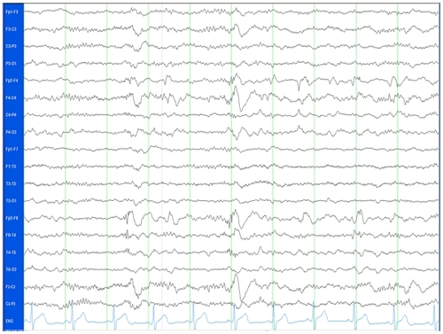 Figure 3B An EEG time segment displaying independent right frontal and right temporal spikes.