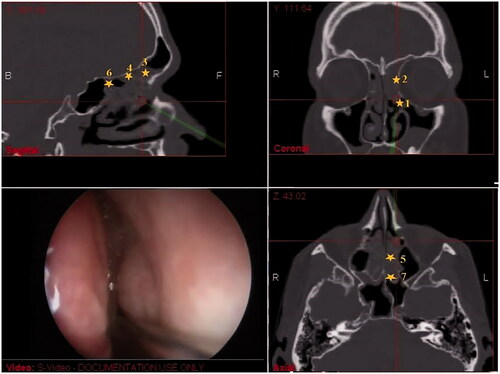 Figure 2. Seven reliable landmarks in NESS: (1) Maxillary sinus ostium; (2) Any point on the orbital wall; (3) Frontal recess; (4) Any point on the skull base; (5) Ground lamella; (6) Fovea posterior; and (7) Sphenoid sinus ostium.