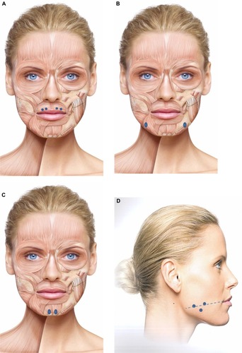 Figure 2 Injection sites to treat each lower facial indication, as recommended by the expert panel.