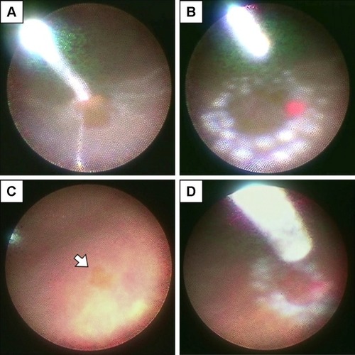 Figure 2 Representative images under the 25-gauge ophthalmic endoscope.