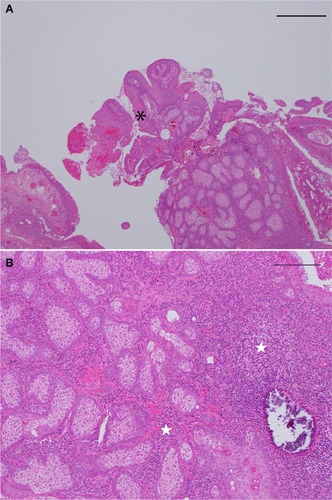 Figure 2 Histopathological findings on staining with H&E.