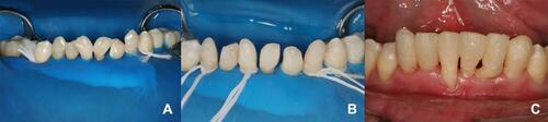 Figure 8 Reanatomization of lower incisors with composite resin. (A) Isolation with a rubber dam; (B) details of the isolation; (C) clinical aspects after the reanatomization.