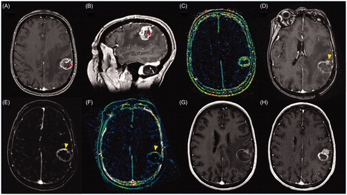 Figure 3. Images of 66-year-old female patient with metastatic breast cancer to the brain with a tumor recurrence after treatment with SRS. (A) Pre-ablation axial T1C + MRI showing a heterogeneous ring-enhancing lesion in the left frontoparietal region, compatible with recurrent tumor, note the large caliber vessel in the anterior third of the lesion (red arrow); (B) Pre-ablation sagittal T1C + MRI showing the large caliber vessel crossing the lesion; (C) ) Pre-ablation Dynamic Contrast-Enhanced k-trans MR showing a high signal intensity in the lesion’s margins compatible high vascularization; (D) Post-ablation axial T1C + MRI showing the classic eggshell enhancement in the margins of the ablation, notice in the anterior margin a solid enhancement compatible with unablated tissue (yellow arrow), it is possible that the large vessel worked as a heat sink preventing the complete ablation of the lesion; (E) Post-ablation MRI subtraction showing increased enhancement in the anterior margin of the ablation zone (yellow arrow); (F) Post-ablation axial Dynamic Contrast-Enhanced k-trans MR showing increased signal in the anterior margin of the ablation zone (yellow arrow); (G) One month post-ablation axial T1C + MRI showing eggshell enhancement a remnant unablated tumor in the anterior margin of the ablation zone; Three months post-ablation axial T1C + MRI showing tumor recurrence in the anterior part of the ablation zone.
