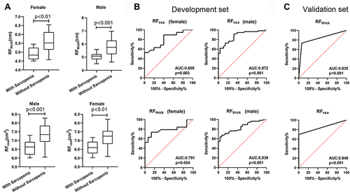 Figure 1 The predictive value of RFthick and RFcsa. (A) The RFthick and RFcsa were differed between patients with sarcopenia and patients without sarcopenia; Receiver operating characteristic curve analysis of RFthick and RFcsa for the prediction of sarcopenia in the development set (B) and the validation set (C).