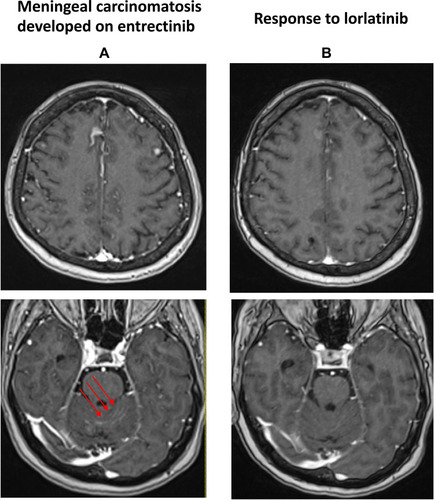 Figure 2 Major meningeal response to lorlatinib, both at the internal frontal level (upper panel) and in the posterior fossa (lower panel, red arrows). (A) Meningeal progression to entrectinib. (B) Response to lorlatinib after six weeks of treatment.