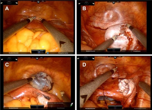 Figure 3 The ovarian cystectomy using the new single-port platform: (A) The robot was fully docked, and two semirigid robotic instruments were placed in the pelvic cavity. (B) An incision was made in the cyst wall with a hook monopolar cautery. The robotic grasper and suction irrigation were used to remove the capsule of the cyst. (C) The ovarian cyst was completely removed. (D) The 4-0 absorbable suture was used to seam the surgical incision in the ovarian. The ovary recovered to normal appearance.