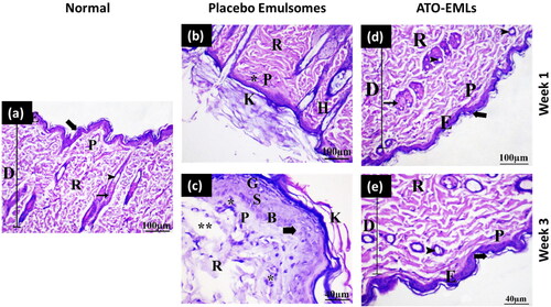 Figure 9. In-vivo skin irritation test: (a) Normal skin: This shows the two layers of the skin, the epidermis (E) and the dermis (D). The dermis shows an outer papillary layer (P), an inner reticular layer (R), and hair follicles (arrowhead) associated with sebaceous gland (arrow). The stratum corneum consists of many layers of flattened non-cellular acidophilic keratin scales (bold arrow). (b) Placebo emulsomes after 1 week: Hyperkeratosis (K), increased thickness of the stratum corneum with non-nucleated corneocytes, due to alteration in epidermal cell turnover and differentiation of superficial keratinocytes. Hyperkeratosis is a common sequel of chronic epidermal disease and is caused by increased turnover of epidermal cells or decreased desquamation of corneocytes. Hyperkeratosis can be a sign of skin irritancy. Perifollicular and intrafollicular infiltration of neutrophils, lymphocytes, and mononuclear cellular infiltration in the dermis (*). (c) Placebo emulsomes after 3 weeks: The epidermis (E) and dermis (D) are seen in this figure. Hair follicles (arrowhead) related with sebaceous glands (arrow) can be seen in the dermis’ outer papillary layer (P) and an inner reticular layer (R). Flattened non-cellular acidophilic keratin scales cover most of the stratum corneum (bold arrow). (d) ATO-EMLs after 1 week: The dermis shows focal areas of collagen loss or empty space (**) of variable sizes. Increased cellular proliferation of the epidermis and epithelial hyperplasia is the most common spontaneous, non-neoplastic lesion of the skin (bold arrow). Hyperkeratosis (K). Perifollicular and intrafollicular infiltration of neutrophils, lymphocytes, and mononuclear cellular infiltration in the dermis (*). (e) ATO-EMLs after 3 week. These are the two layers that make up the skin. The epidermis (E) and the dermis (D) may be seen here. The dermis can be broken down into two distinct layers: the outside papillary layer (P), the inner reticular layer (R). There was hair follicle (arrowhead). The stratum corneum is made up of multiple layers of keratin scales that are non-cellular and acidophilic and have been flattened (bold arrow). Mononuclear cellular infiltration in the dermis (*) was detected.